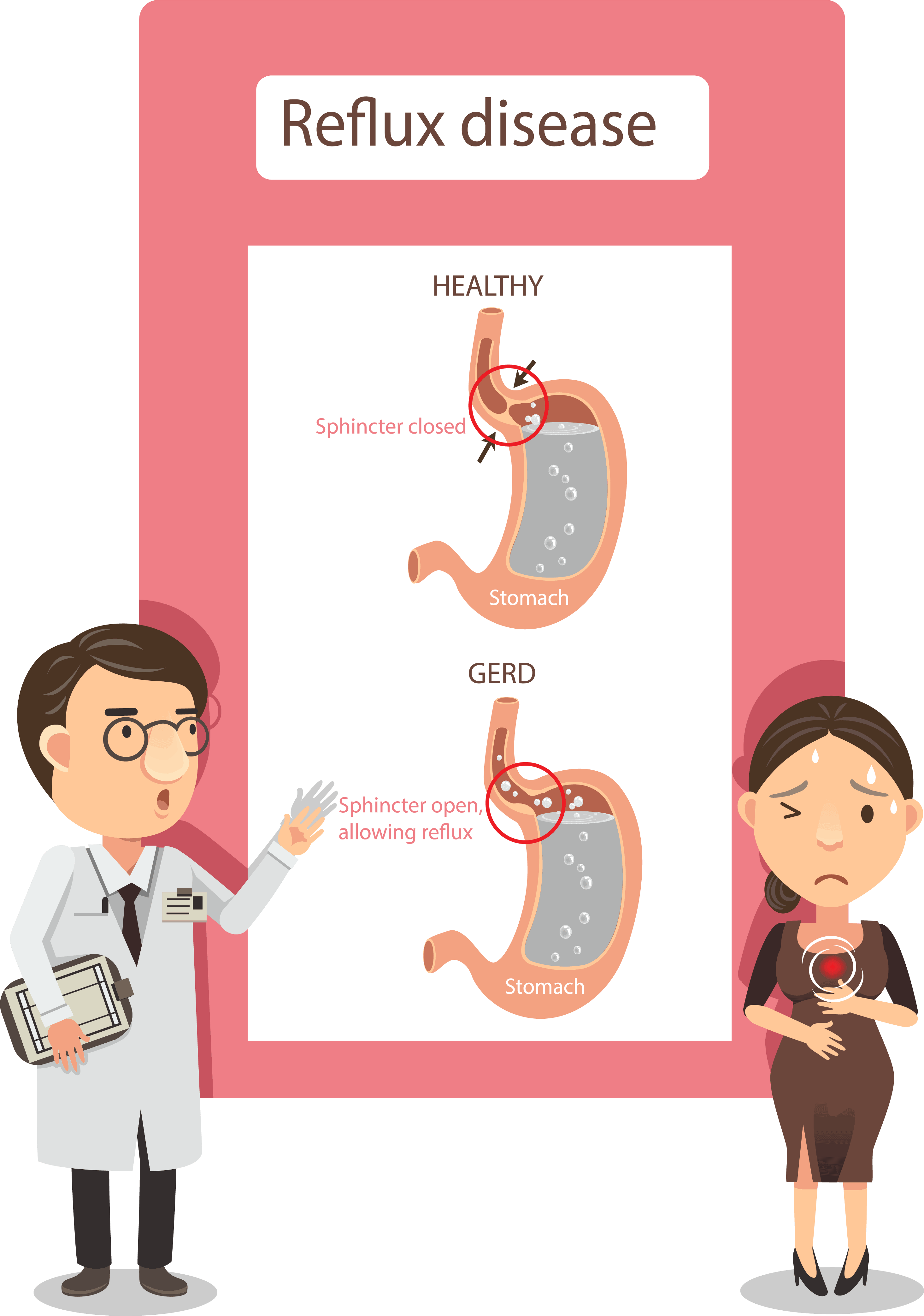 Educational illustration comparing healthy esophagus and GERD.